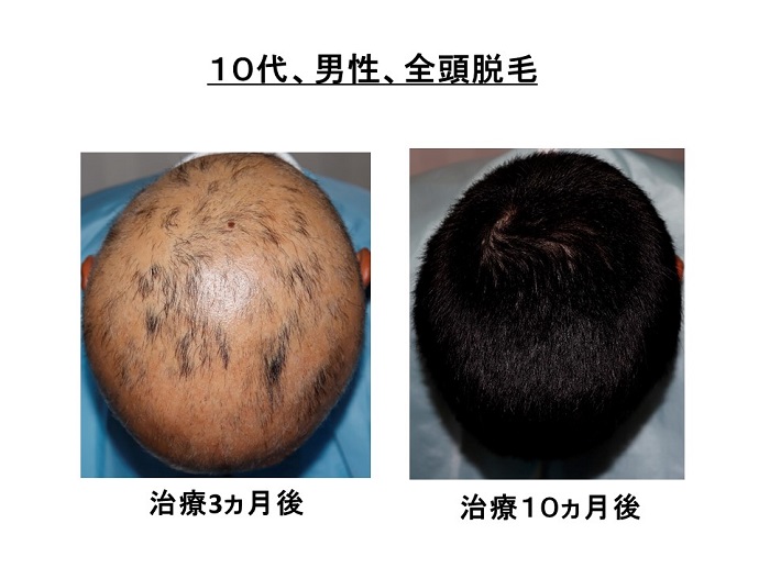 円形脱毛症　病院
